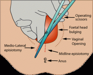 episiotomy